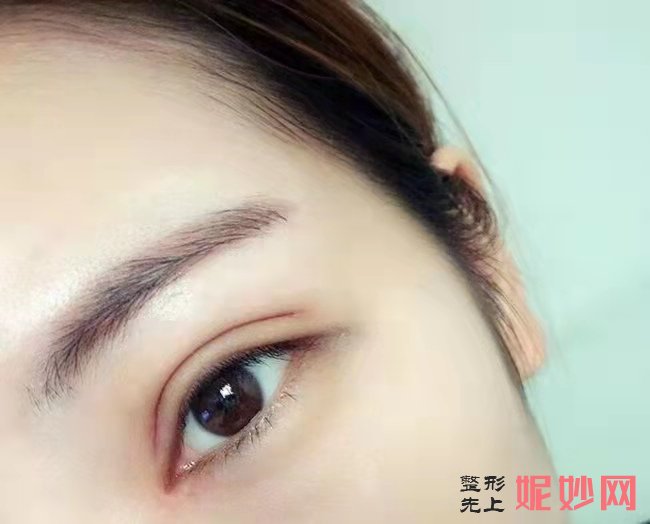 选择四川人民整形外科游晓波做双眼皮，不会后悔！