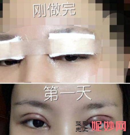 四川省人民整形外科傅荣双眼皮效果真是太美了！
