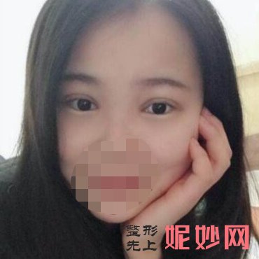 四川省人民整形外科傅荣双眼皮效果真是太美了！