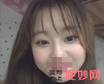 四川省人民整形外科傅荣双眼皮效果真是太美了！