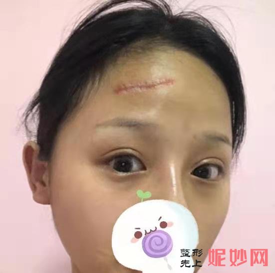 看四川省人民整形外科傅荣疤痕修复效果图展示！
