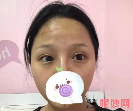 看四川省人民整形外科傅荣疤痕修复效果图展示！