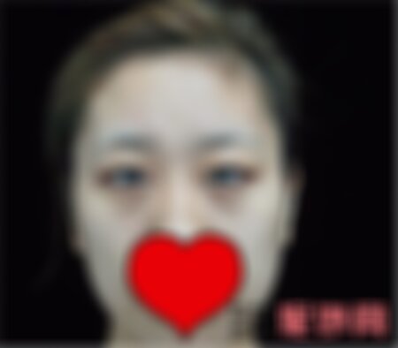 重庆华美整形美容做眼袋怎么样？