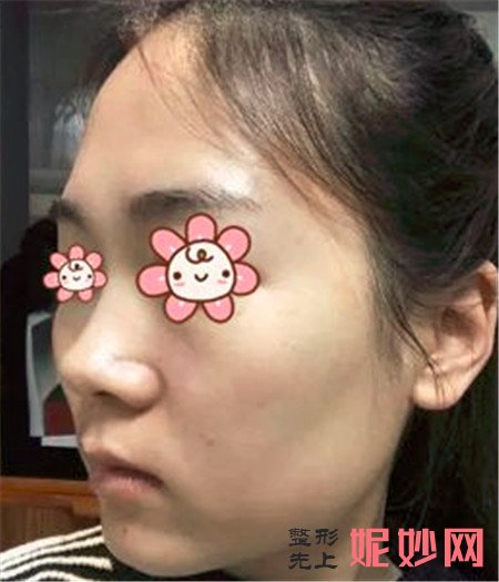 重庆华美张国强做鼻子怎么样？