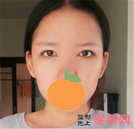重庆华美陈凯修复眼睛怎么样？