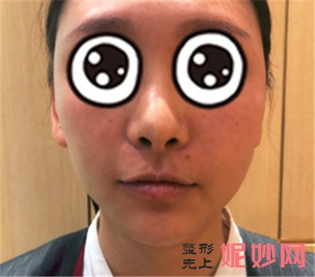 华美陈凯医生做面部脂肪填充怎么样？