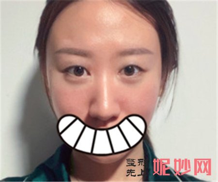 谷琪做双眼皮怎么样？