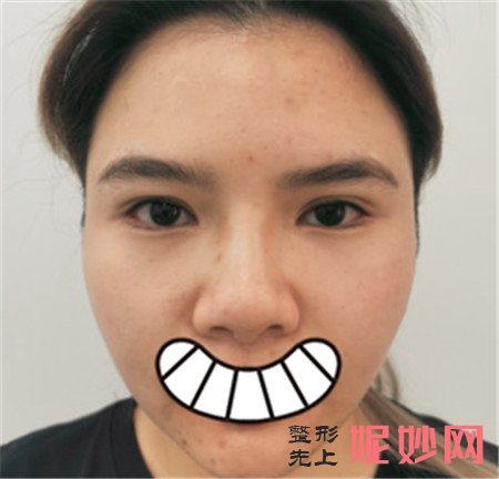 华美石海山医生做鼻子做的好吗？