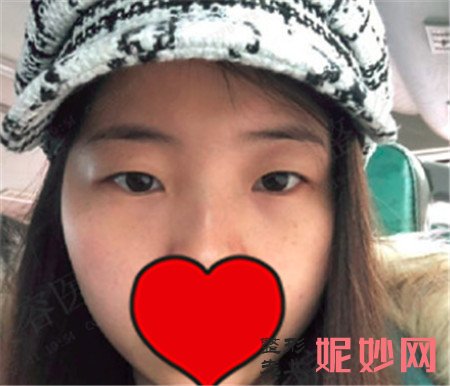 华美张梅做眼睛怎么样？