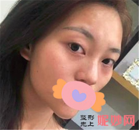重庆华美杨加富做眼睛怎样？