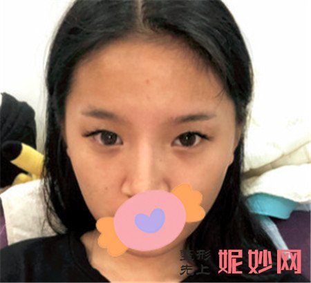 何春涛做双眼皮怎么样？
