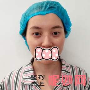金东勋做双眼皮怎么样？