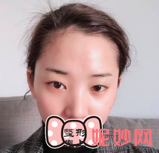高伟成双眼皮怎么样？