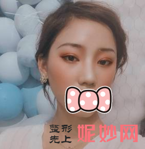 高伟成双眼皮怎么样？