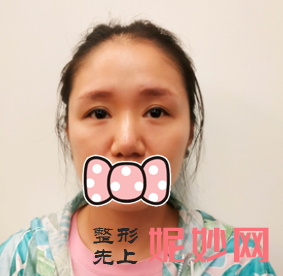 上官文松做鼻子怎么样？