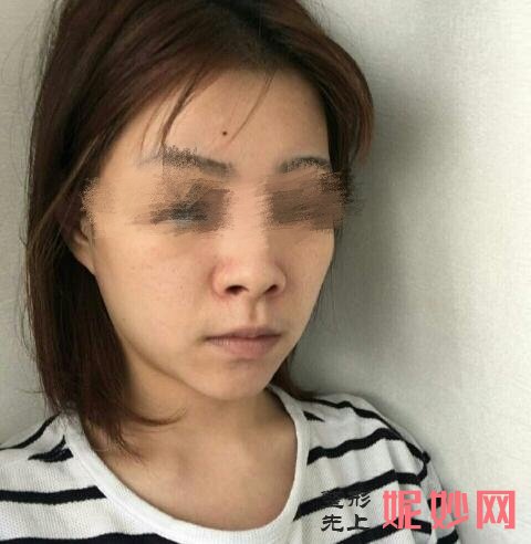 广州韩秀医疗美容医院怎么样？医生介绍+鼻综合分享
