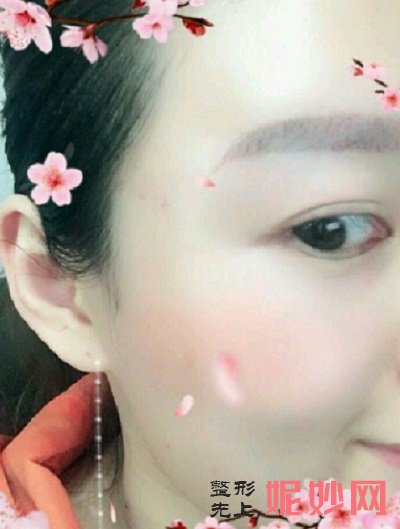 深圳北大医院整形科何君君做自体脂肪填充怎么样？面部脂肪填充效果大公开！