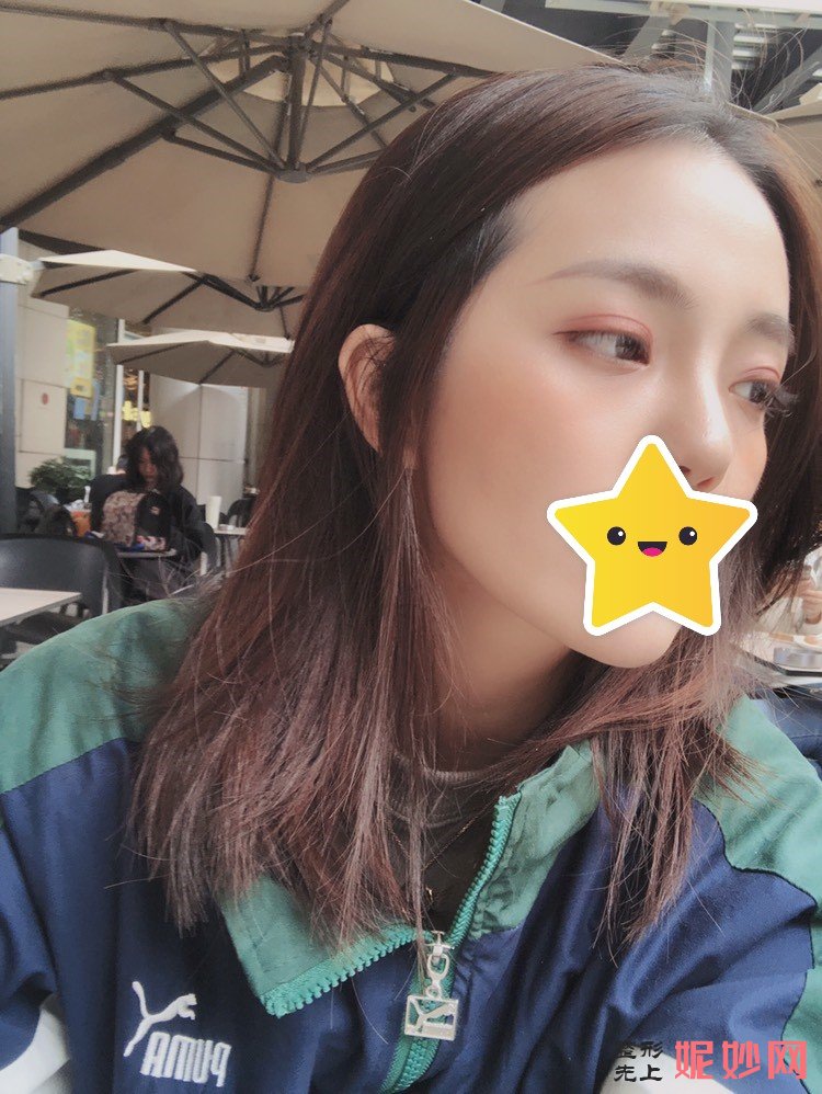 崔永言做双眼皮效果怎么样？帮你实现较美的双眼皮！