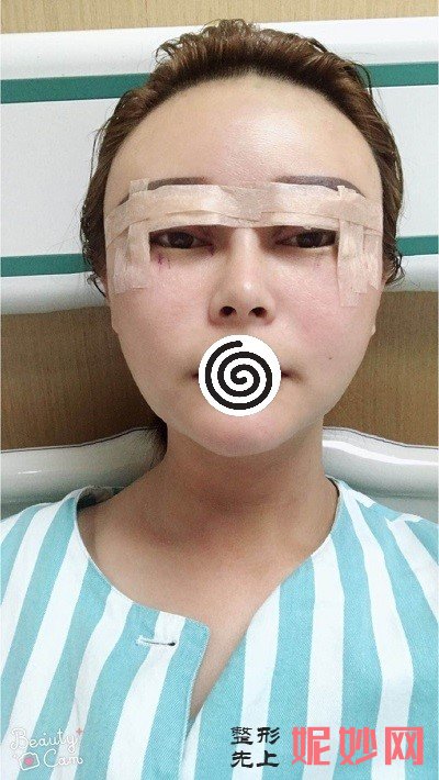 深圳北大崔永言做修复双眼皮怎么样？快来看看真实案例分享吧！