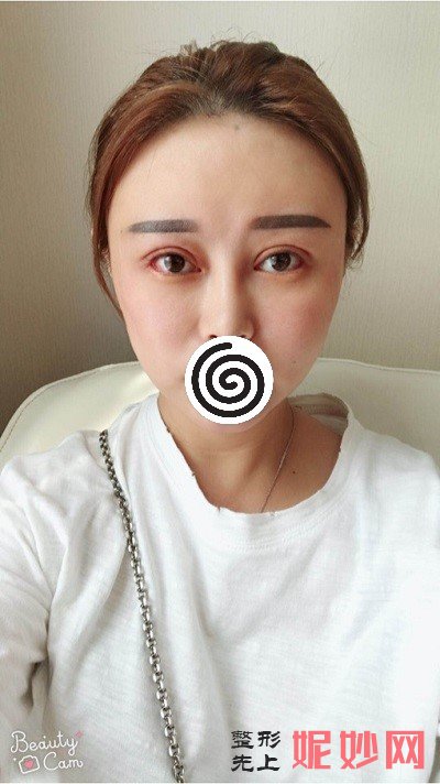 深圳北大崔永言做修复双眼皮怎么样？快来看看真实案例分享吧！