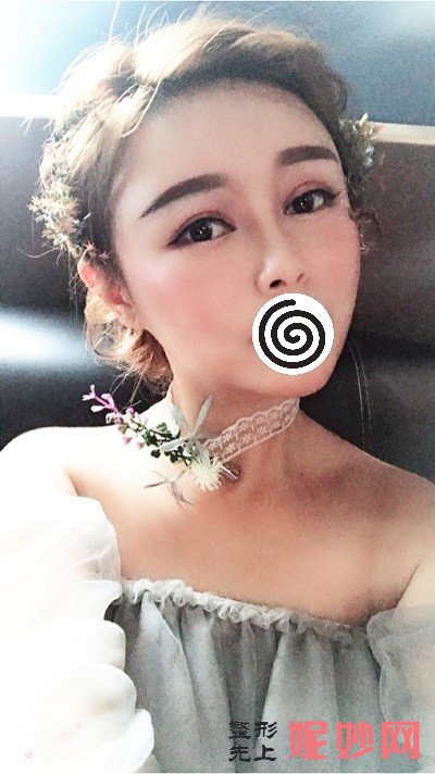 深圳北大崔永言做修复双眼皮怎么样？快来看看真实案例分享吧！