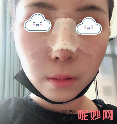 深圳北大医院崔永言做鼻综合好不好？看我恢复的整个过程吧！