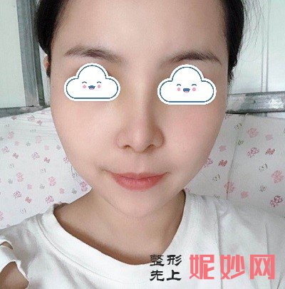 深圳北大医院崔永言做鼻综合好不好？看我恢复的整个过程吧！