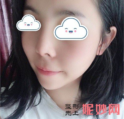 深圳北大医院崔永言做鼻综合好不好？看我恢复的整个过程吧！