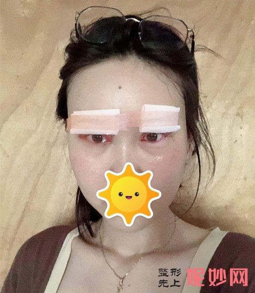 深圳北大医院整形科李天石做双眼皮好吗？双眼皮效果分享，让你成为较靓的崽！