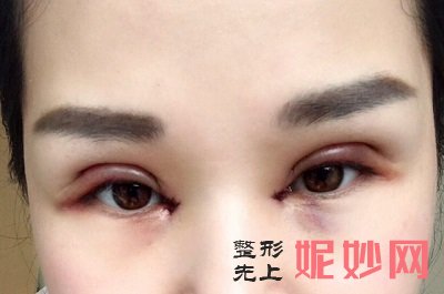 找李天石做修复双眼皮靠谱吗？度过消肿期后就是美丽的都市丽人！