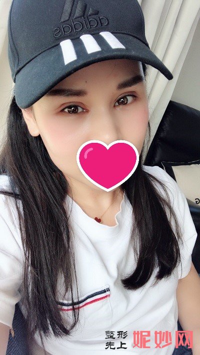 找李天石做修复双眼皮靠谱吗？度过消肿期后就是美丽的都市丽人！