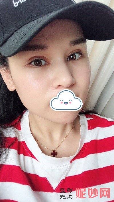 找李天石做修复双眼皮靠谱吗？度过消肿期后就是美丽的都市丽人！