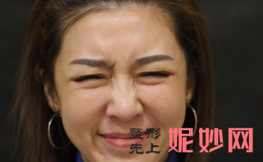 成都美立方医疗美容整形医院李建军除皱效果怎么样？皮肤平滑白嫩！
