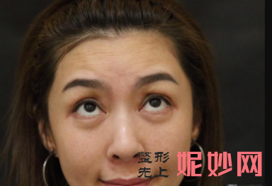 成都美立方医疗美容整形医院李建军除皱效果怎么样？皮肤平滑白嫩！