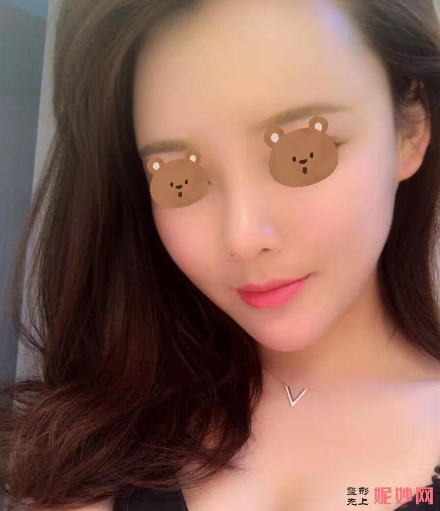 成都美立方医疗美容整形医院谭拯隆鼻手术效果好不好？鼻子挺拔自然！