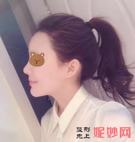 成都美立方医疗美容整形医院谭拯隆鼻手术效果好不好？鼻子挺拔自然！