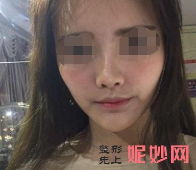 成都美立方医疗美容整形医院谭拯鼻修复鼻手术怎么样？效果超级赞！