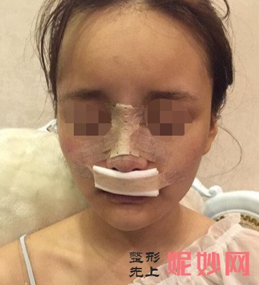 成都美立方医疗美容整形医院谭拯鼻修复鼻手术怎么样？效果超级赞！