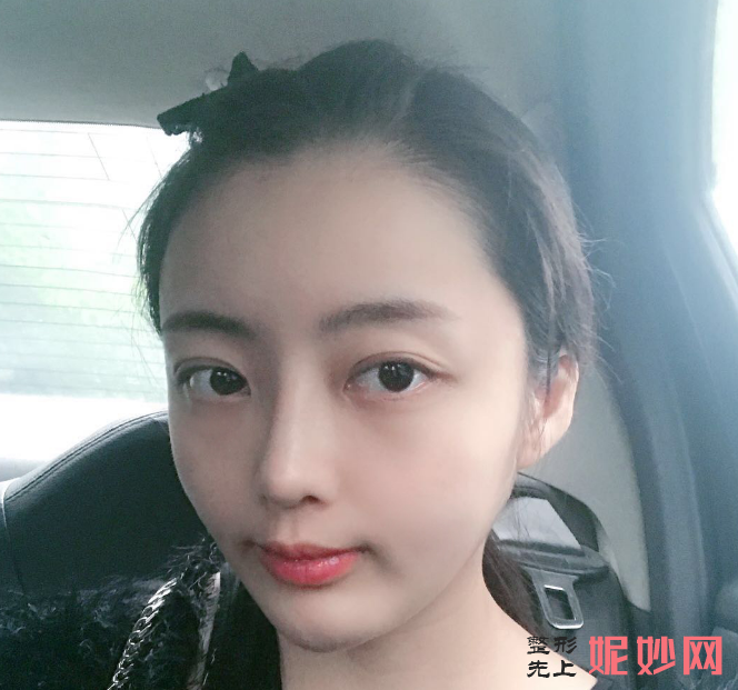 成都美立方医疗美容整形医院宋华敬面部脂肪填充术怎么样？超级减龄！
