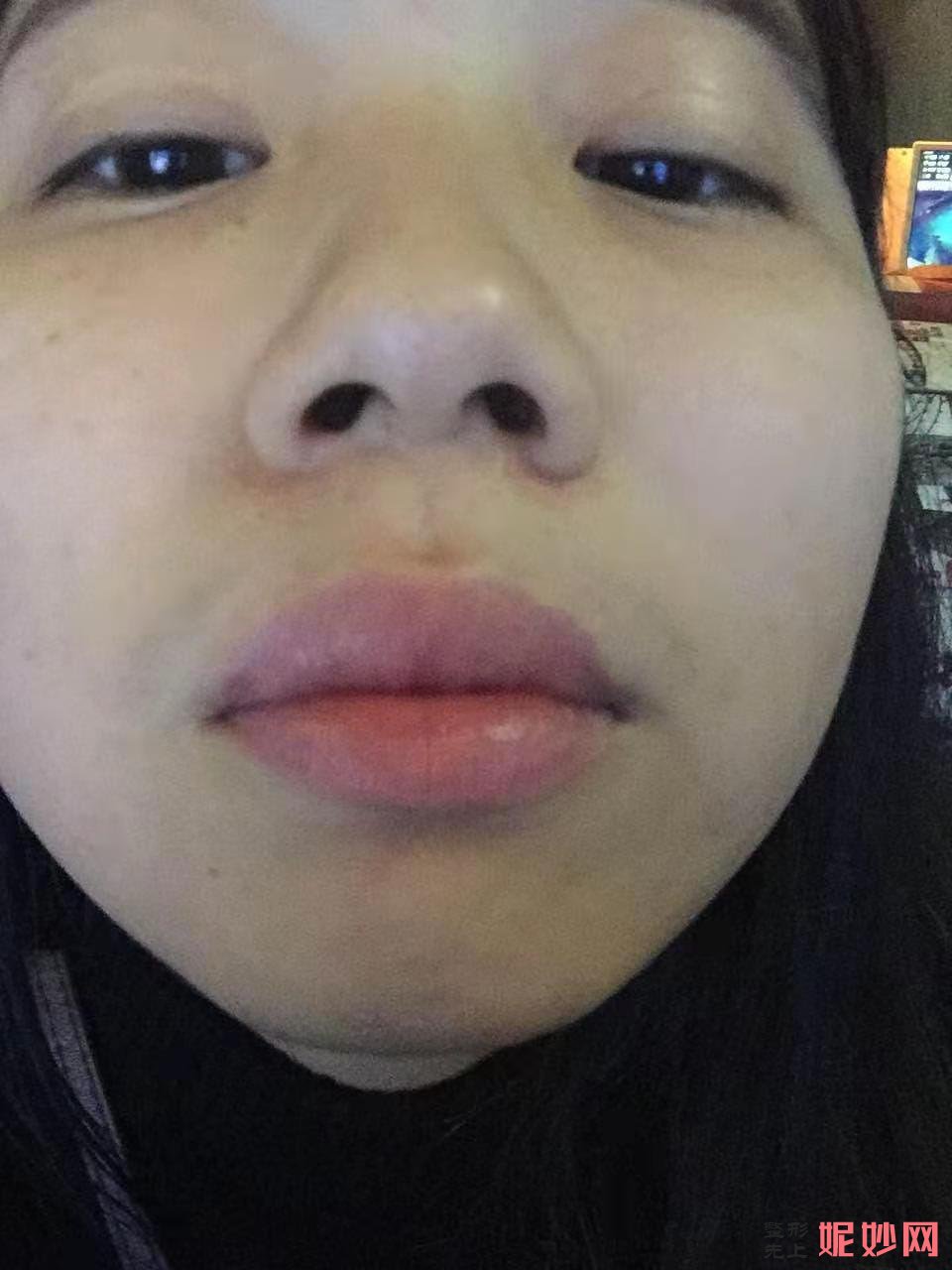 成都美立方医疗美容整形医院宋华敬隆鼻手术好不好？效果超级自然！