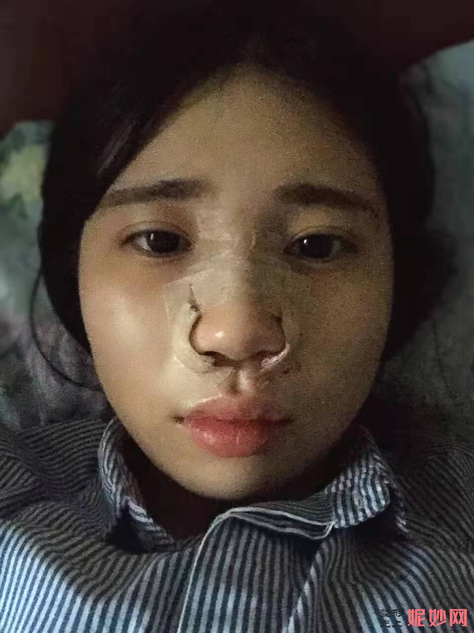 成都美立方医疗美容整形医院宋华敬隆鼻手术好不好？效果超级自然！
