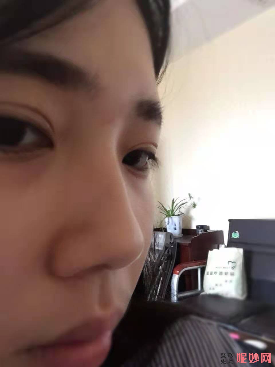 成都美立方医疗美容整形医院宋华敬隆鼻手术好不好？效果超级自然！