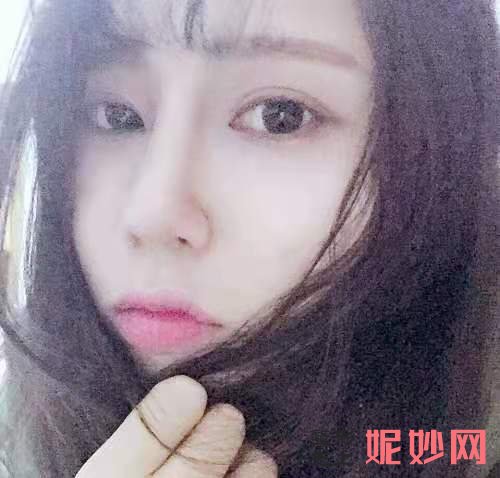 成都美立方医疗美容整形医院宋华敬隆鼻手术好不好？效果超级自然！