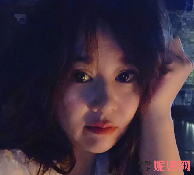 成都美立方医疗美容整形医院侯文婕面部年轻化怎么样？术后自信满满！
