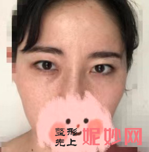 易东风做双眼皮怎样？
