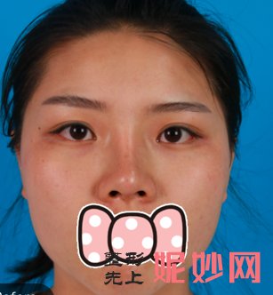 赵贵庆医生做的鼻子怎么样？