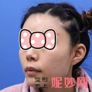 柳超医生磨骨怎么样？