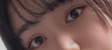 南京高伟成双眼皮怎么样?附双眼皮案例
