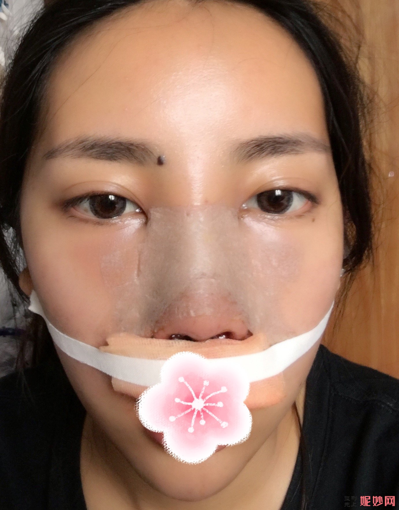北京西美斯医疗美容耳软骨隆鼻费用多少钱？