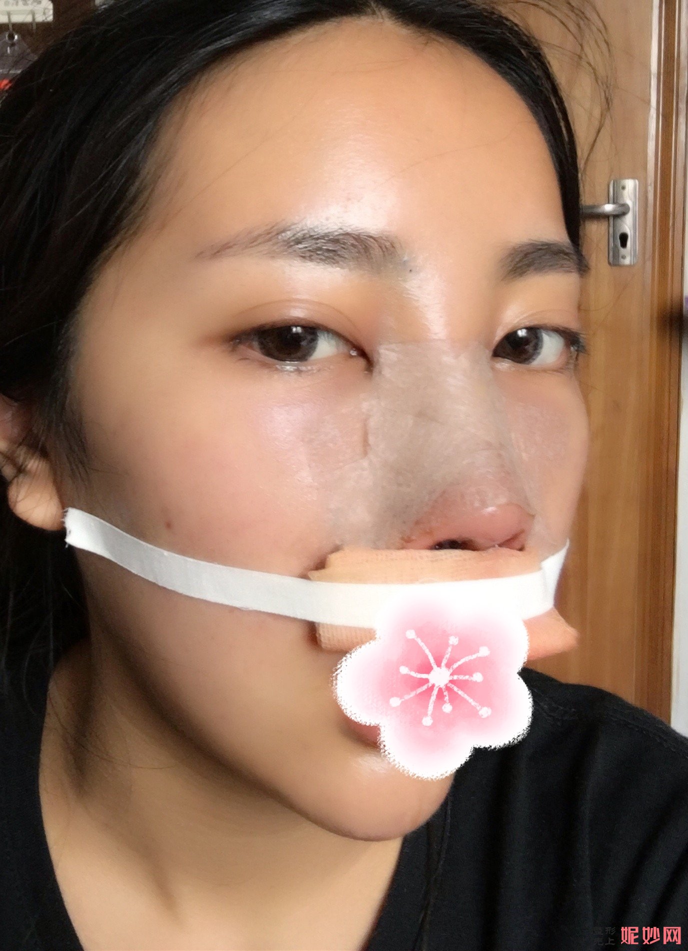 北京西美斯医疗美容耳软骨隆鼻费用多少钱？